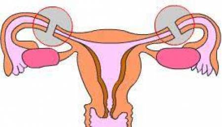 Cómo lograr un embarazo si tengo la salpingo